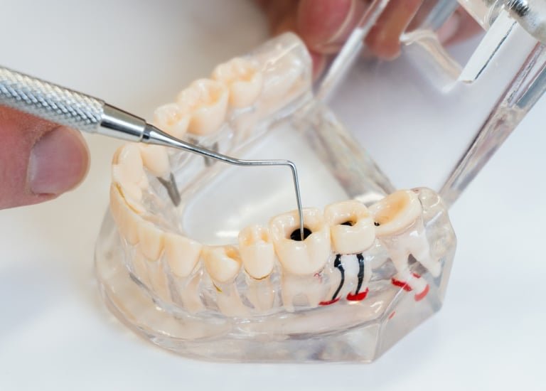 Save the tooth instead of losing it
